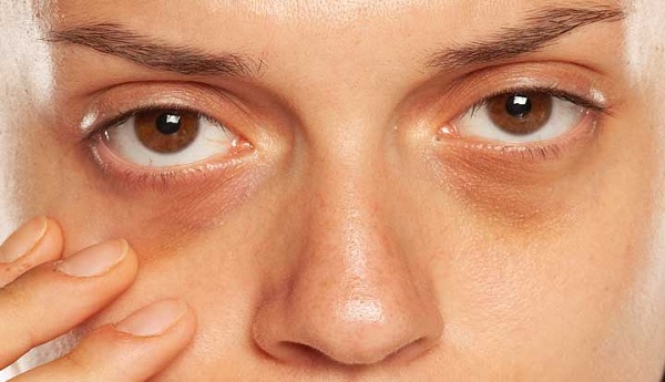 35 cách loại bỏ quầng thâm mắt và bọng mặt